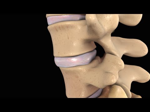 Back Pain: Lumbar Disc Injury - UC85VW73bQLEjs_taFKP7TwQ