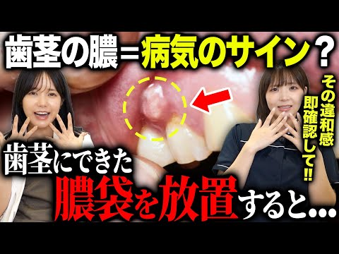 【要注意？】歯茎にできた「膿」を放っておいたら最後はどうなるの？