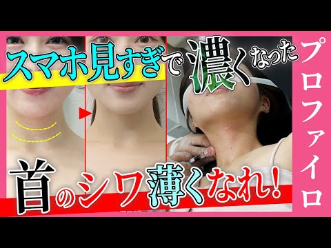 【首のシワを消す】シワが刻まれたスマホ首が爆増中！注射で薄くなるか観察してみる【プロファイロ1回の効果は？】湘南美容クリニック