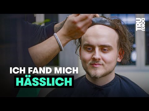 Kahler Kopf: Dennis fand sich hässlich | TRU DOKU