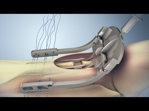 Achilles Tendon Rupture and Repair | Nucleus Health - UC85VW73bQLEjs_taFKP7TwQ