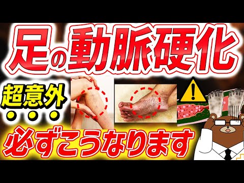 【危険】知らないと後悔する。がんより死亡率が高い「足の動脈硬化」の要注意な危険サイン。進行すると起きる初期症状とは？足は第二の心臓。足の血管を守るためにできるお手軽な予防法は？医師が完全解説。