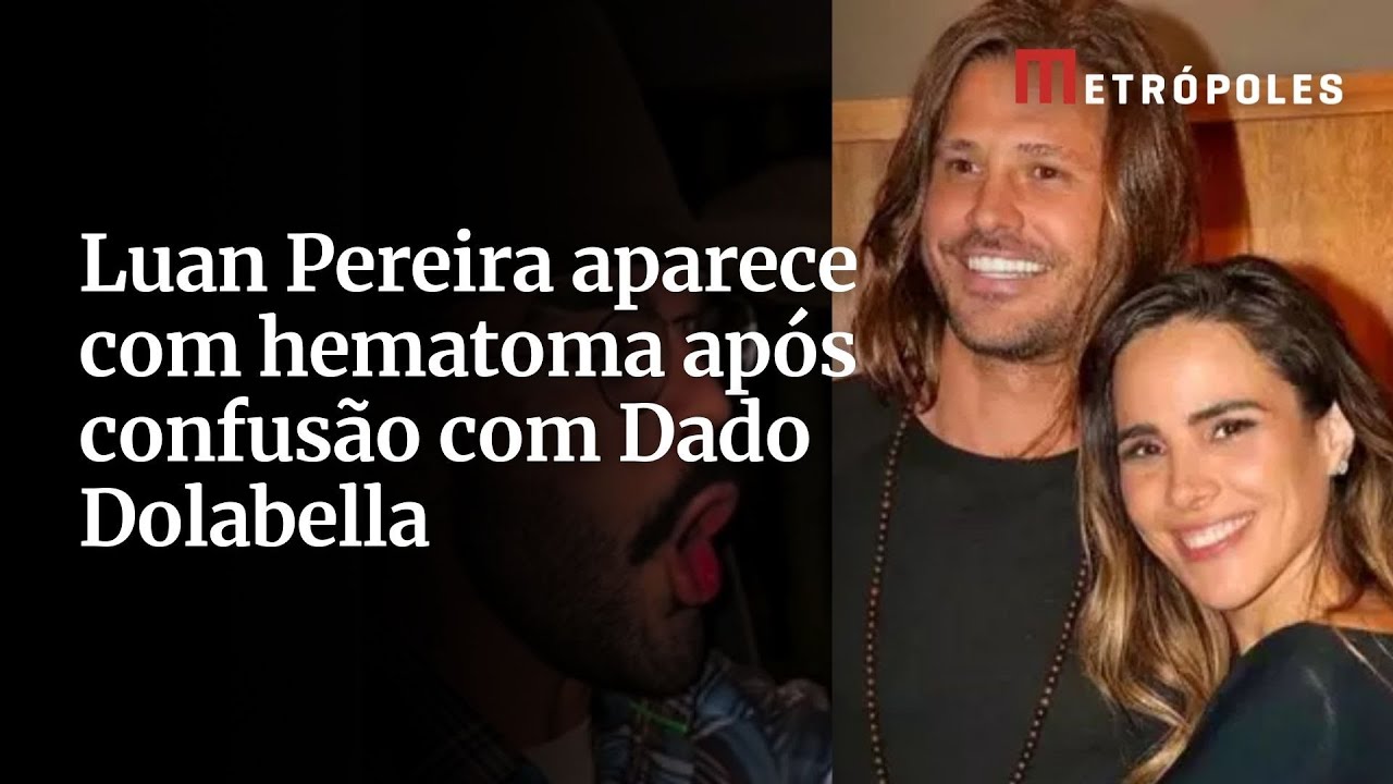 Luan Pereira aparece com hematoma após confusão com Dado Dolabella