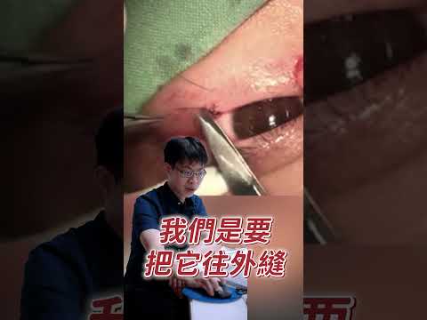 不只是工作的時候！大家平常做家事也要小心唷🥹 #蕭家杰醫師 #高雄眼科醫師 #屏東眼科醫師 #大學眼科 #眼科手術 #眼瞼受傷 #鼻淚管