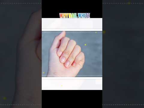 Ever wondered why these white spots appear on your nails? 🤔