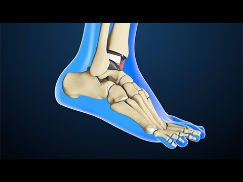 Total Ankle Replacement Surgery | Nucleus Health - UC85VW73bQLEjs_taFKP7TwQ