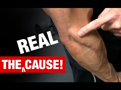 The Truth About Tennis Elbow (WHAT REALLY CAUSES IT!) - UCe0TLA0EsQbE-MjuHXevj2A