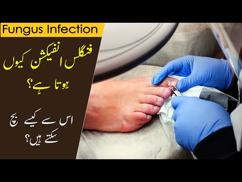 Fungal Infection causes | How to treat Fungal Infection | Tips by Dr. Abdul Yahya