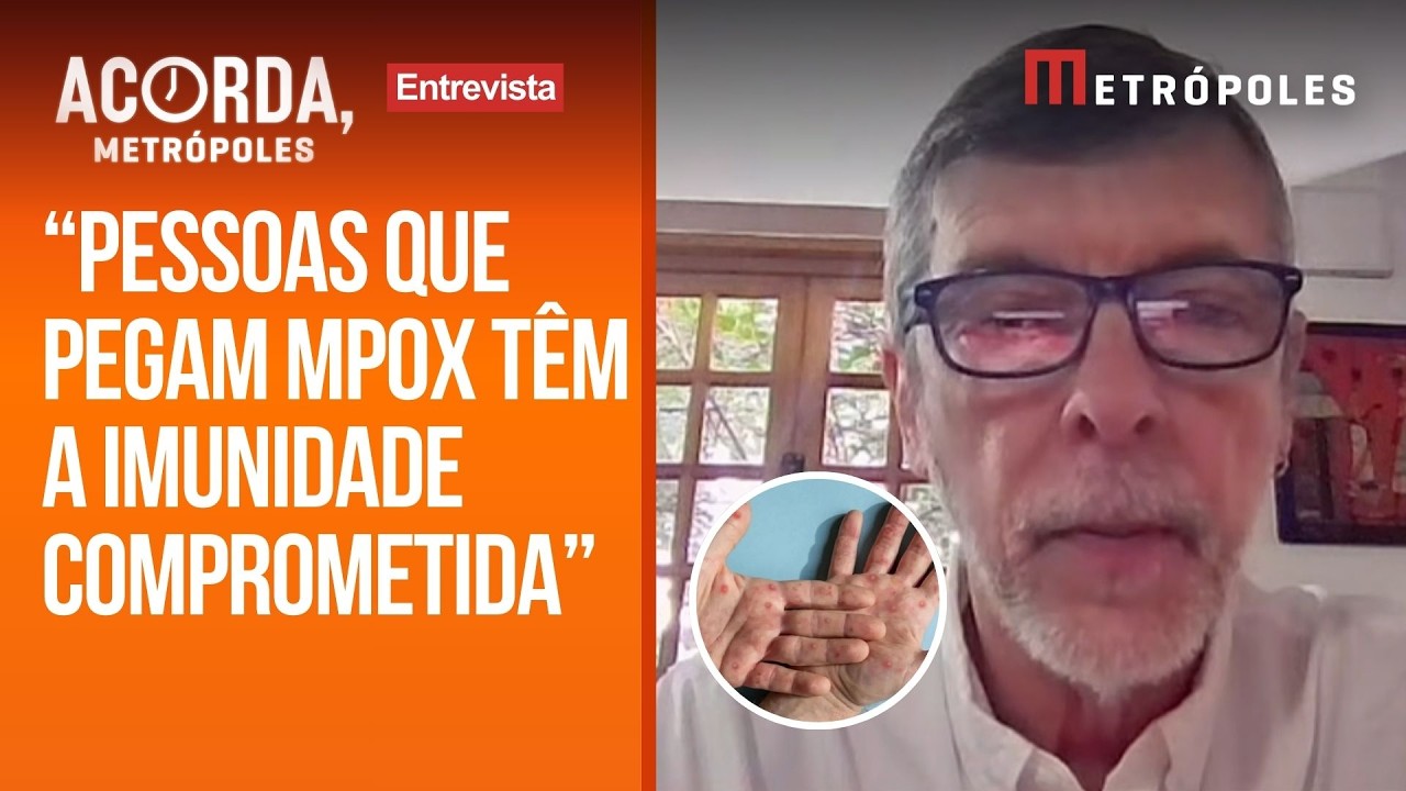 “Não vivemos em situação de surto ou epidemia”, diz médico sobre MPOX