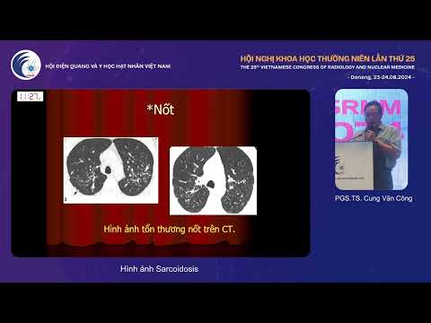 2. Hình ảnh Sarcoidosis (PGS.TS. Cung Văn Công)