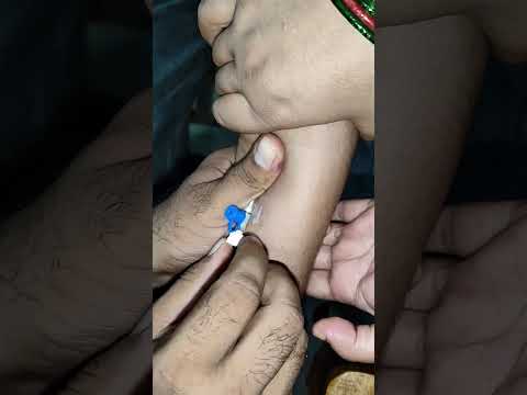 cannulation #cmbbs #nurse #hospital #mbbsprivatecolleges