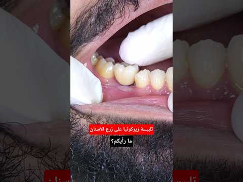تلبيسة خلفية زيركونيا على زرعة للاسنان