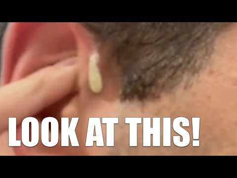Biggest Comedones and Zits 2023