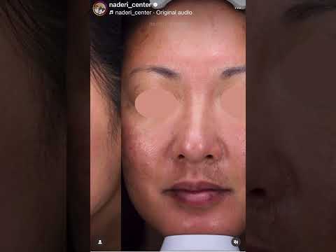 Non surgical skin tightening without the downtime ✨ #skintightening #morpheus8 #noninvasive