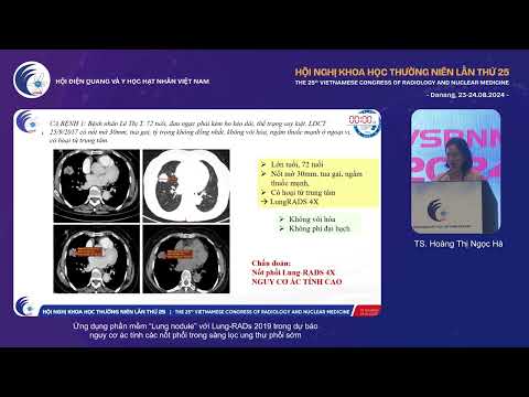 4. Phần mềm "Lung nodule" với Lung-RADs 2019 dự báo nguy cơ ác tính nốt phổi (TS. Hoàng Thị Ngọc Hà)