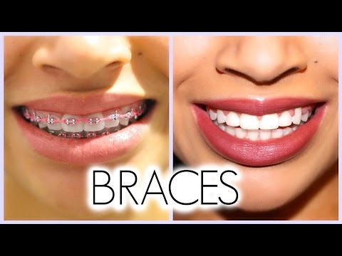 MY 3 YEAR BRACES EXPERIENCE!! (Before/After + Q & A) - UCT5yFEDO-zY1D1vrPyglmsg