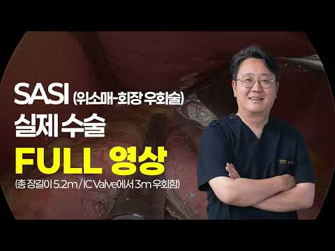 비만대사수술 중 우회술의 하나, SASI(위소..