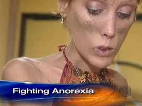 Anorexia's Childhood Roots (CBS News) - UClzCn8DxRSCuMFv_WfzkcrQ