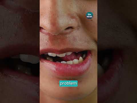 Are weight loss jabs ruining teeth? #itvnews #ozempic #teeth