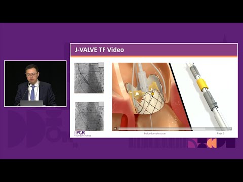 A dedicated TAVI valve for aortic regurgitation: the J-VALVE solution - PCR London Valves 2024