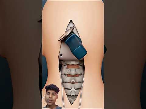 😃ऑपरेशन करने का तरीका 😃