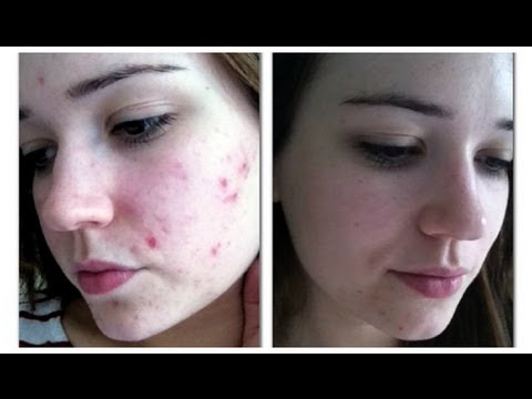 Skin Care Routine Before and After - UC-1-zPmT368J8JRbsK_1keA