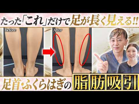 【症例紹介】美脚を作る脂肪吸引！ダイエットで痩せない脚がここまで変わる【ふくらはぎ 足首】