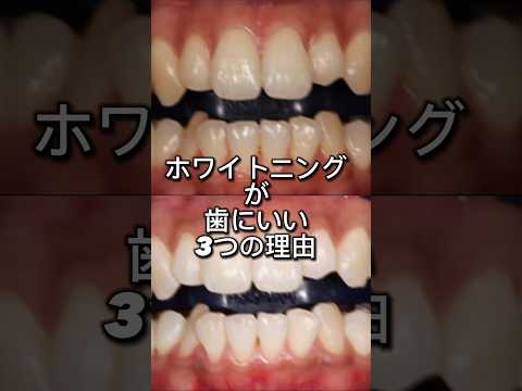 ホワイトニングモニターで6,000円オフ✨　予約は『🔍湘南歯科クリニック池袋院』で検索！#ホワイトニング #湘南歯科クリニック #虫歯予防 #歯周病