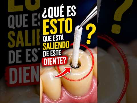 😳 ¿Qué está saliendo de dentro de este diente?