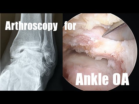 Arthroscopy for Ankle OA　変形性足関節症に対する関節鏡手術