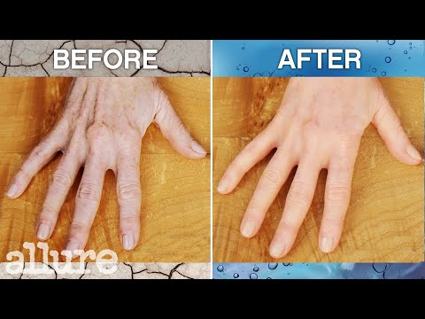 Dermatologist Explains How Hand Filler Works | Allure