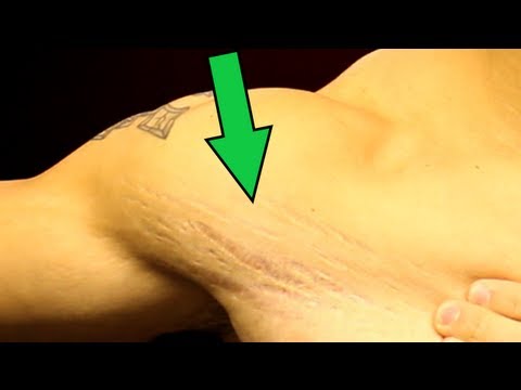 Stretch Marks - What Can You Do? - UCHZ8lkKBNf3lKxpSIVUcmsg